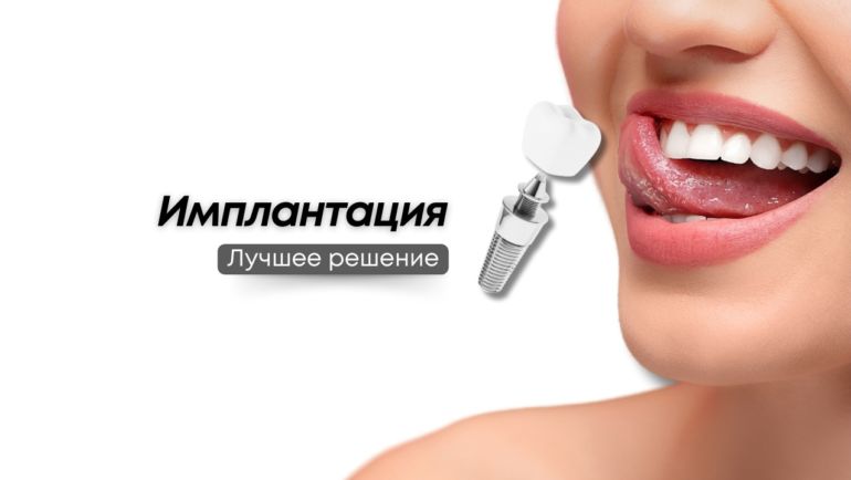 Лучшее решение — имплантат по специальной цене за 36 500₽